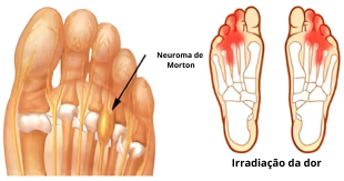 Palmilha para Neuroma de Morton